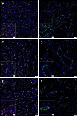 Phosphorylated Forms of STAT1, STAT3 and STAT5 Are Expressed in Proliferating but Not Involuted Infantile Hemangioma